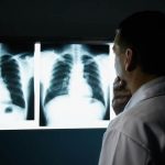 Médico alerta para riscos da tuberculose pulmonar não tratada