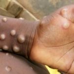 Rio tem primeiro caso de varíola dos macacos
