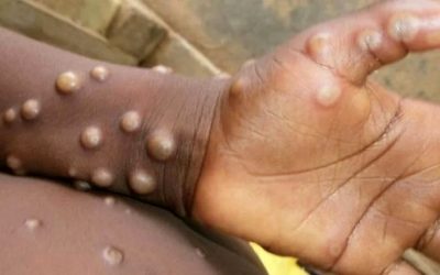 Ministério da Saúde confirma mais dois casos de varíola dos macacos