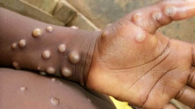 Rio tem primeiro caso de varíola dos macacos