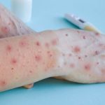 Saúde confirma sétimo caso de varíola dos macacos no país