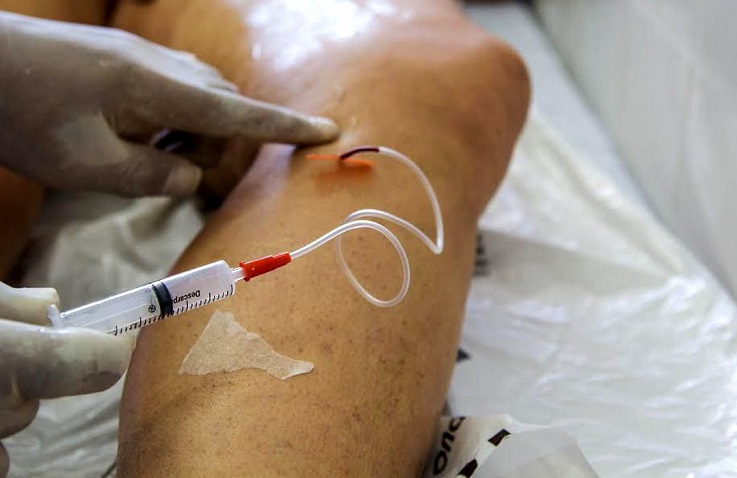 Doença venosa crônica é fator de risco para problemas cardiovasculares